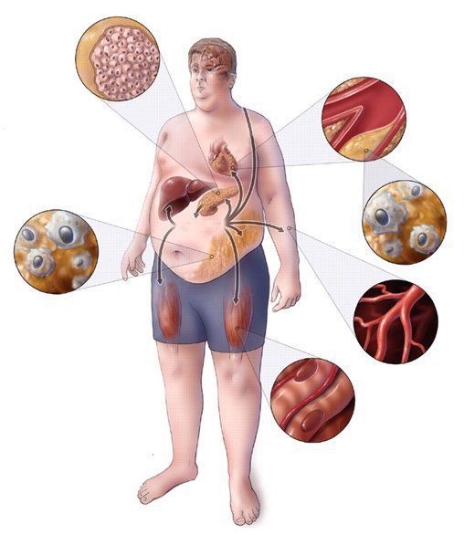 Метаболический синдром: причины развития, характерные признаки, особенности лечения и принципы диеты